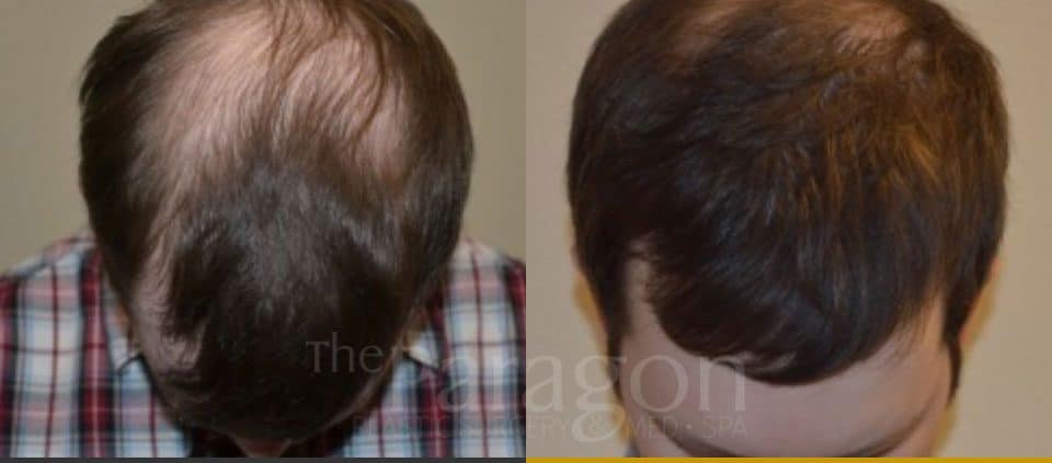 hair transplant paragon clinic 11