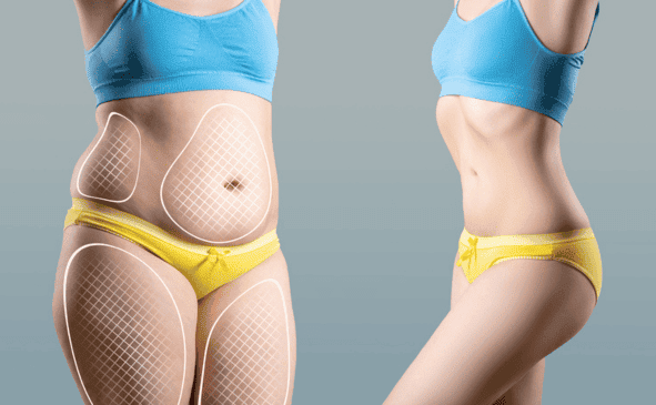  Body Contouring Westworth Village, TX